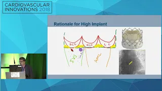 CVI2018 Session: Innovation in Aortic Valve Therapy (Colorado Ballroom, Thursday, July 26, 08:30 am)