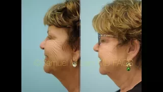 Revolutionary Mesobotox Treatment in Dallas, TX