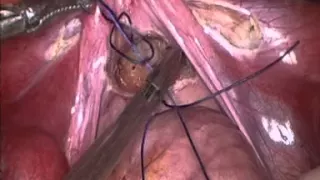 Laparoscopic vaginoplasty by peritoneal pull through by C.P.Dadhich