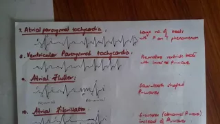 MUST WATCH ECG collection in different diseases now at a single place