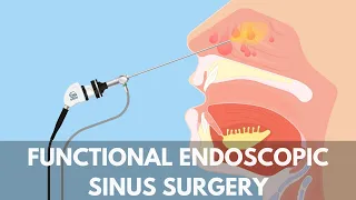 Functional Endoscopic Sinus Surgery Capital ENT