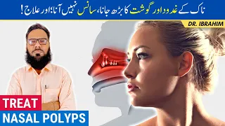 Naak Mein Gosht/Gadood Ka Barh Jana - Nasal Polyps Causes & Treatment - Urdu/Hindi - Dr. Ibrahim