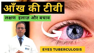 आँख की टीवी लक्षण  इलाज़ और बचाव Eyes tuberculosis