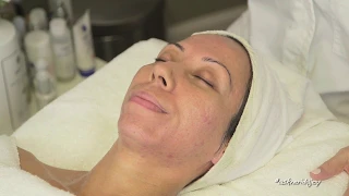 Skin Prepped & Deep Scarring Peel