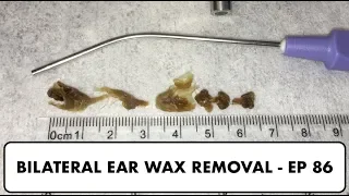 BILATERAL EAR WAX REMOVAL - EP 86