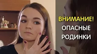 ВНИМАНИЕ! Опасные родинки!