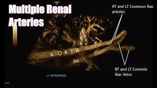 Multiple Renal Arteries