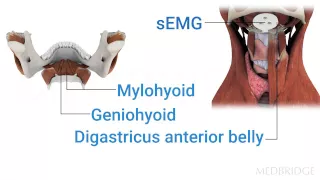 sEMG Biofeedback as an Adjunct in Dysphagia Therapy Video : Michael Crary | MedBridge