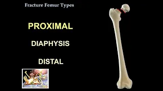 Fracture Femur Types  - Everything You Need To Know - Dr. Nabil Ebraheim