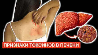 14 признаков того, что ваша ПЕЧЕНЬ ЗАСОРЕНА токсинами и шлаками. 3 продукта для Чистки Печени