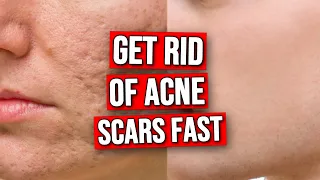 3 DO's & DON'TS To Get Rid of Acne Scars FAST!