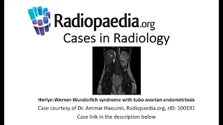 Herlyn-Werner-Wunderlich syndrome with endometriosis (Radiopaedia.org) Cases in Radiology
