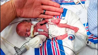 She is the Smallest Surviving Baby Born in the World | STREAM