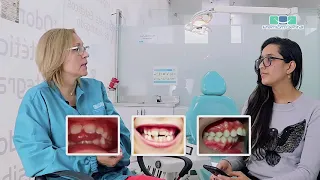 Es normal que a mi hijo le salgan los dientes torcidos?