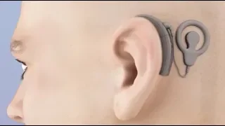 Cochlear Implant Animation