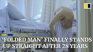 Folded Man Stands Up Straight After 28 Years Following Surgery Break Bones | Miracle