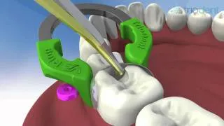 Class II composite restoration using V3 Sectional Matrix System - Triodent.flv