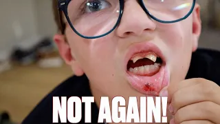 OUCH! NINE YEAR OLD BITES THROUGH HIS LIP WITH TWO KNOCKED OUT BROKEN FRONT TEETH