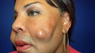 Cosmetic Surgery Disaster: Woman Dubbed 'Cement Face' Given New Lease Of Life