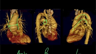 Mediastinal CXR anatomy