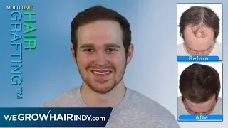 Max Density Hair Transplant | Confidence Restored