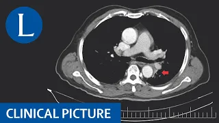 Diagnosing a mediastinal mass