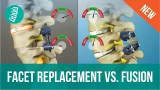 Facet Joint Replacement Vs. Spine Fusion