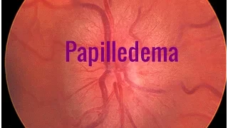 Papilledema A Swollen optic disc