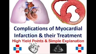 Complications of Myocardial Infarction & their Treatment | High Yield Points | Simple Explanation