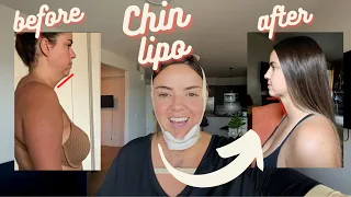 1 YR CHIN LIPO UPDATE