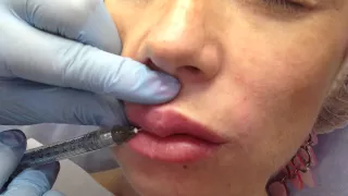 Меди Лайт Увеличение объема губ Филлеры