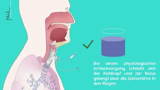 Subglottische Absaugung einer Trachealkanüle | Animation | Andreas Fahl Medizintechnik-Vertrieb GmbH