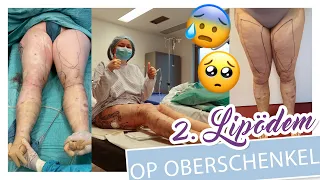OMG 2. LIPÖDEM OPERATION - OBERSCHENKEL - Die Hölle...,Liposuktion, Heilung, Kosten, etc. - YooNessa
