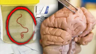 Live 3-Inch Worm Removed From 64-Year-Old Woman’s Brain