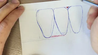 Most common mistakes while drawing mandibular anterior teeth