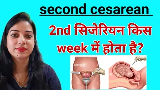 सेकंड सी सेक्शन के लिए कौन सा वीक बेस्ट है? 2nd cesarean konse week me karwa lena chahiye