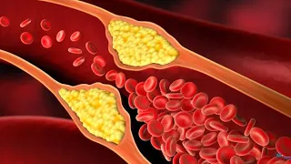 БЛЯШКИ на СТЕНКАХ СОСУДОВ - профилактика и лечение. Очищение сосудов - как это делать.