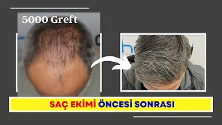 5000 Grafts / Before and after Hair Transplant /7 months later  ( Dr. Hakan DOĞANAY )