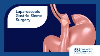 Laparoscopic Gastric Sleeve Surgery 3D Animation