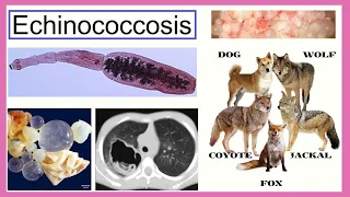 echinococcosis