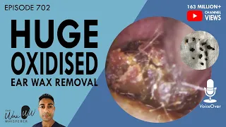 702 - Huge Oxidised Ear Wax Removal