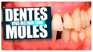 Se você tem Dentes Moles (PERIODONTITE) você precisa assistir esse video