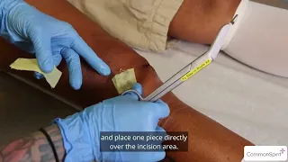 Replacing Bandage - Meniscectomy