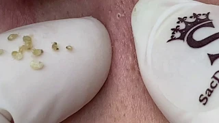 Pimples On The Chin | Mụn Cằm Và Hai Bên Má - SacDepSpa#187