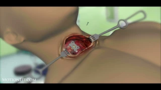 Anterior Cervical Discectomy Surgery Animation