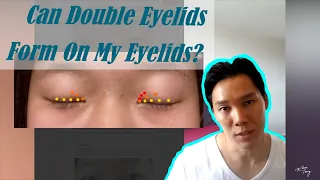 Live Appraisal To See If Double Eyelids Can Be Made