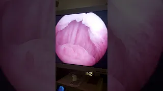 Prostate massage under general anesthesia during Cystoscopy