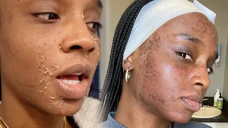 CHEMICAL PEEL | VAMPIRE FACIAL | Full Process | Procedure | Peeling | Before & After