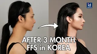 3 MONTHS AFTER FACIAL FEMINIZATION SURGERY IN KOREA