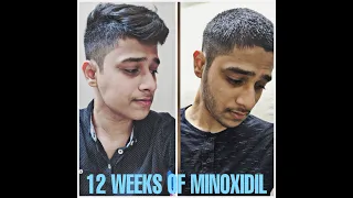 From Clean to Stubble | 12 Weeks Minoxidil Beard Journey | Indian | how to grow Beard